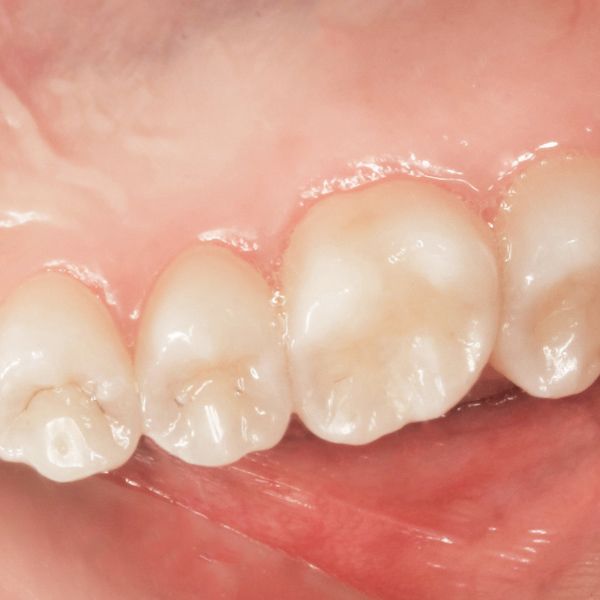 teeth after cavity treatment